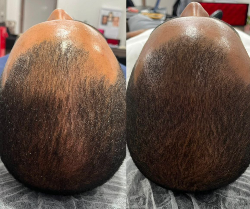 Resultado do tratamento perfect hair