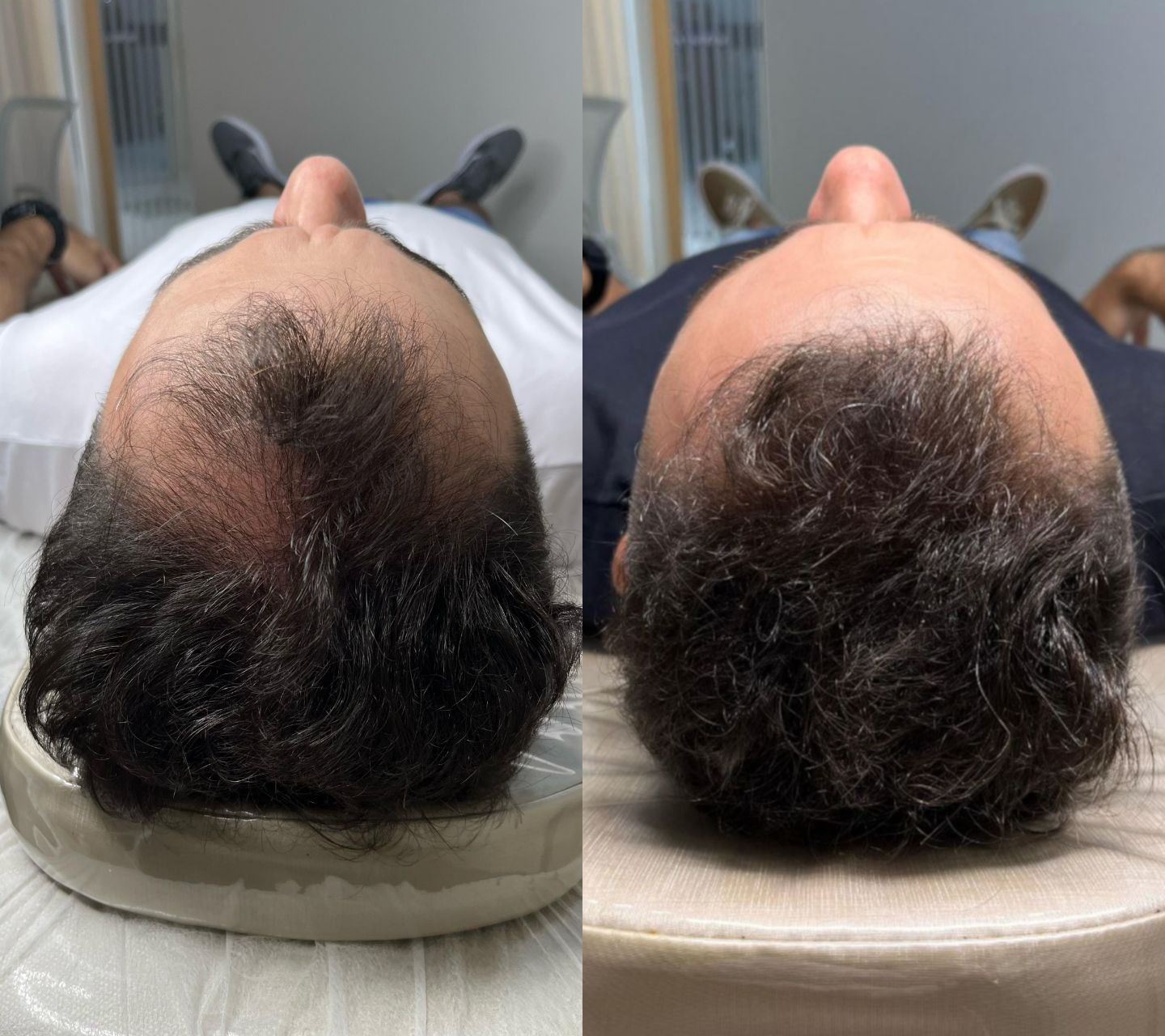 careca-antes-e-careca-depois